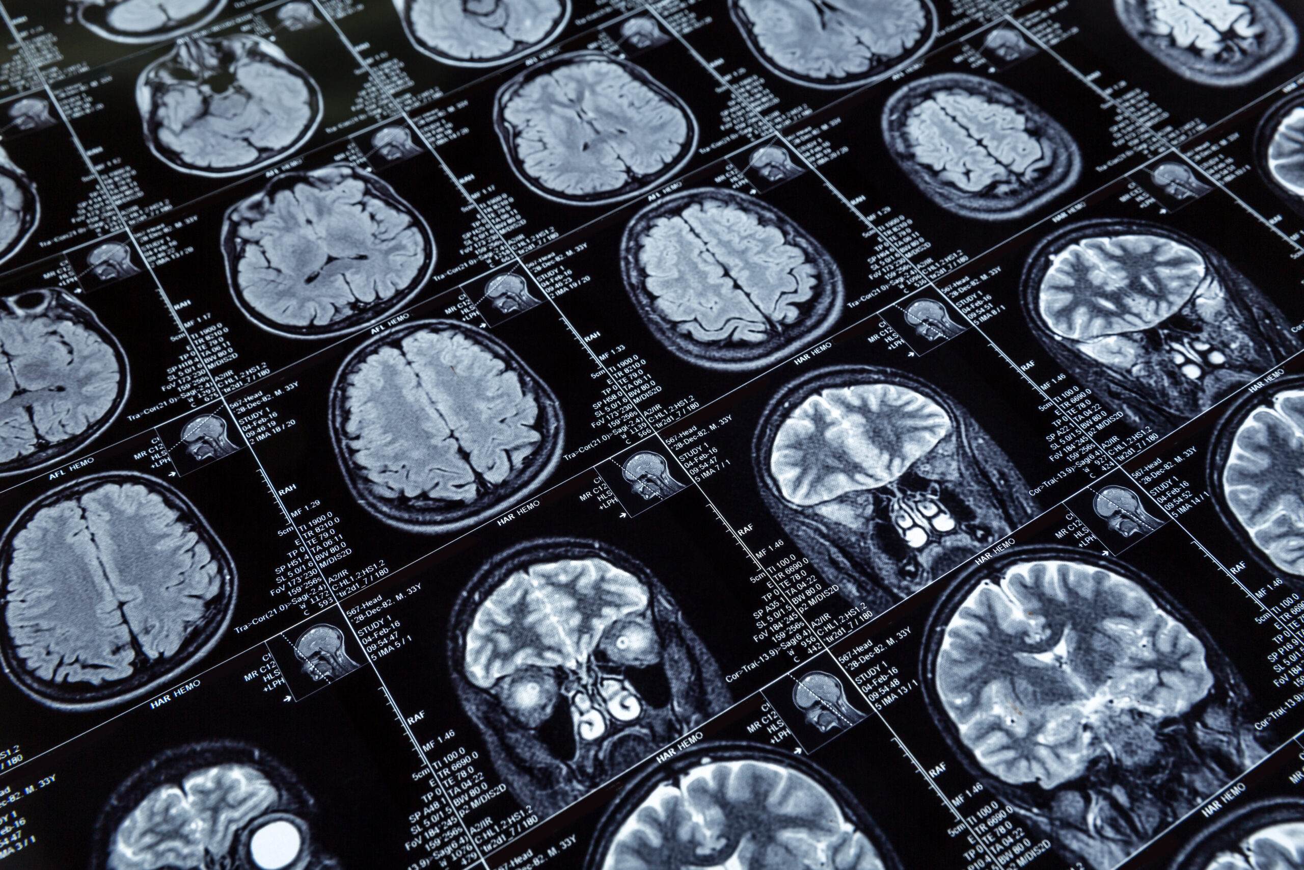 Tratamientos avanzados para tumores cerebrales