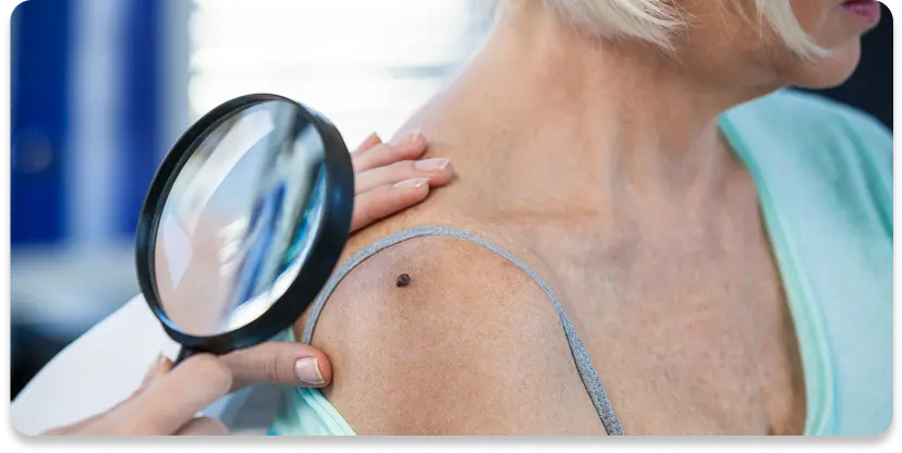 Cáncer de piel y melanoma